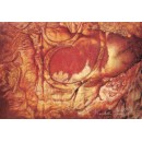 Vaginale, 1992-93